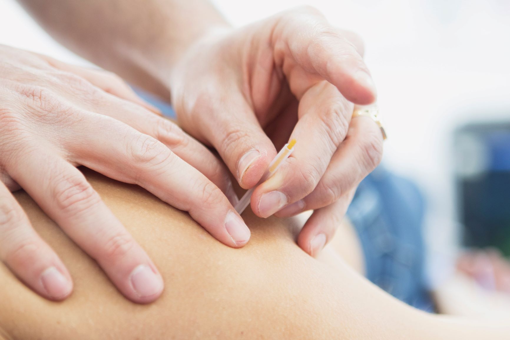 Dry Needling | FysioKort Doesburg