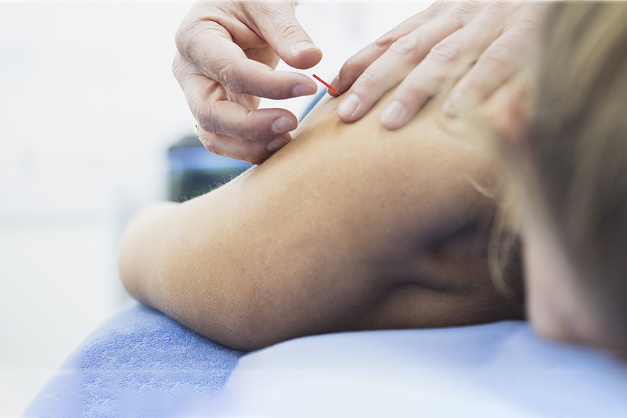 Dry Needling Doesburg | FysioKort