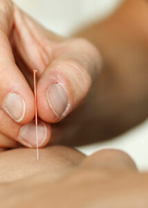 dryneedling