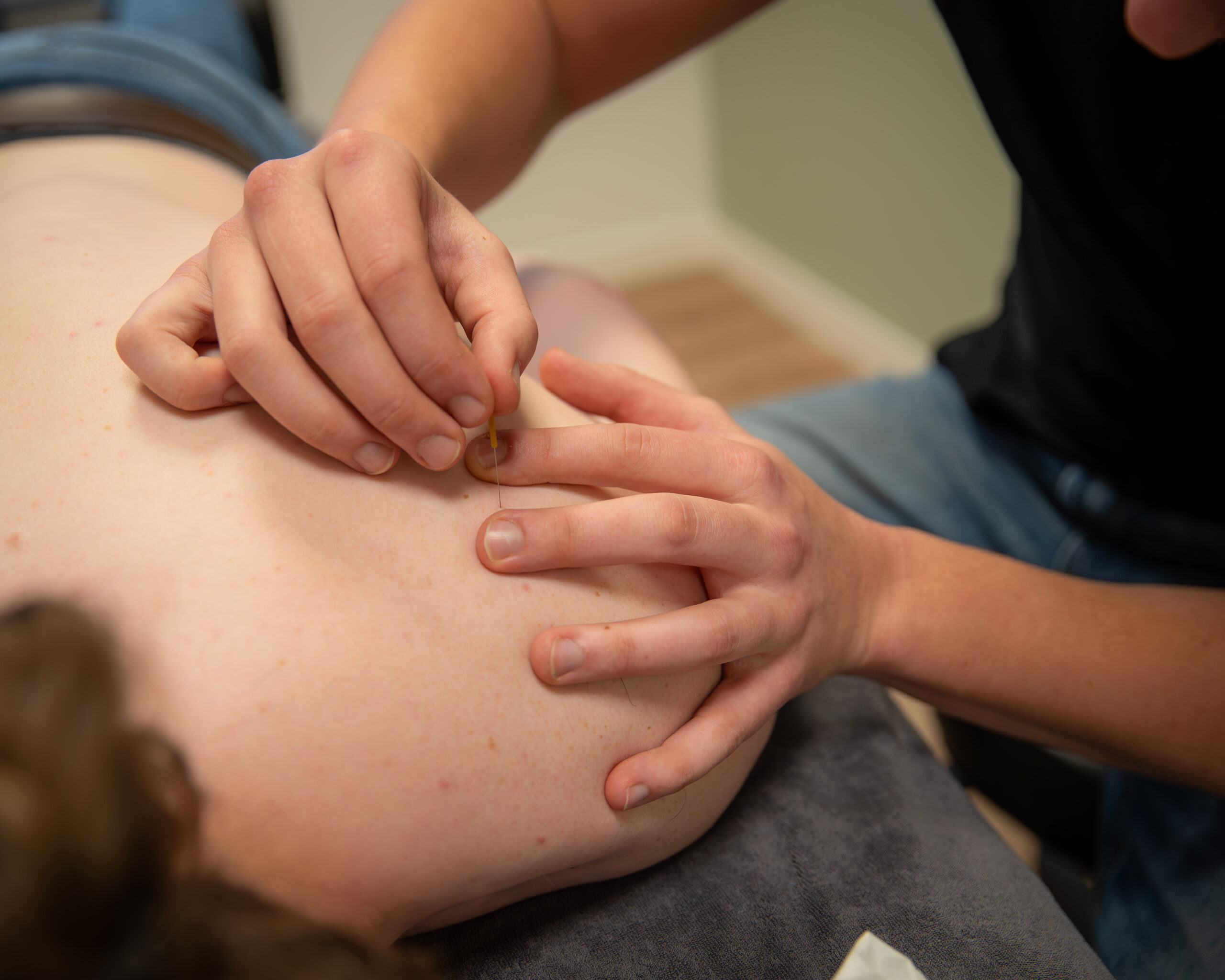Dry Needling | FysioKort Doesburg